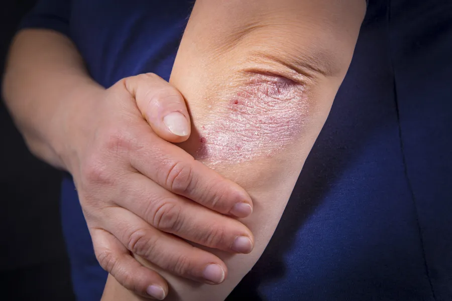 Psorijaza - život sa ovom bolešću