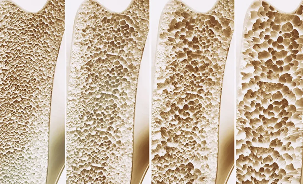 Šta je osteoporoza? 1 šta je osteoporoza