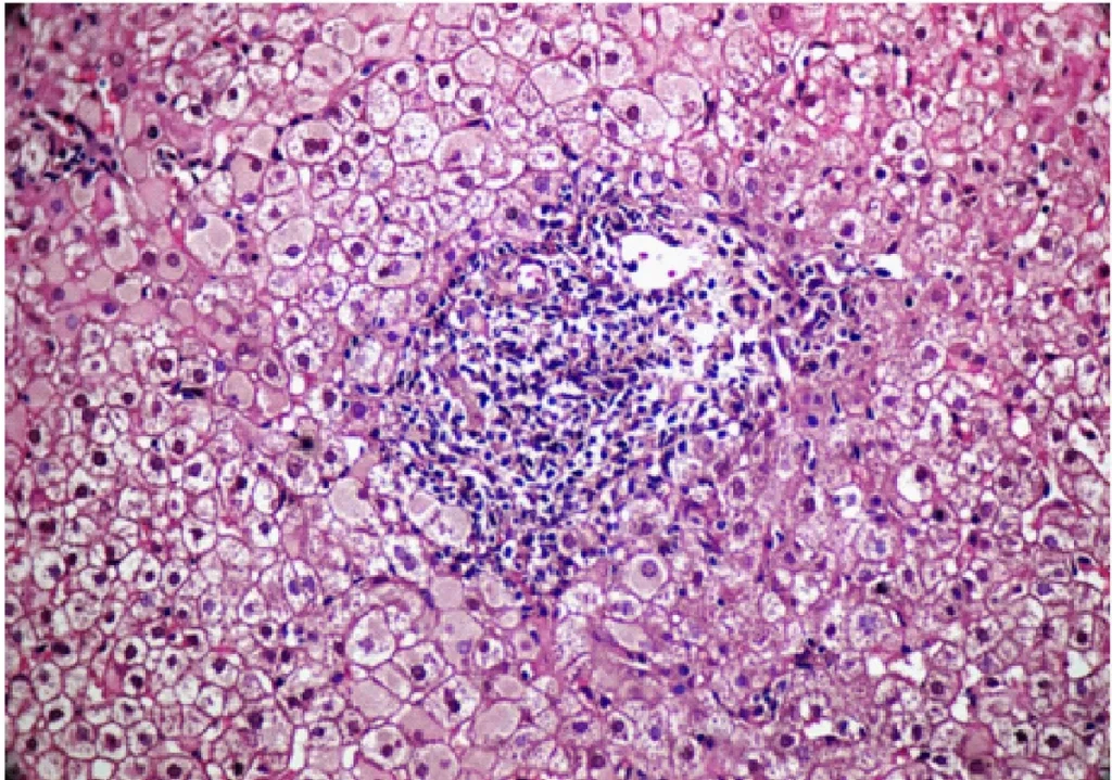 Hronični hepatitis