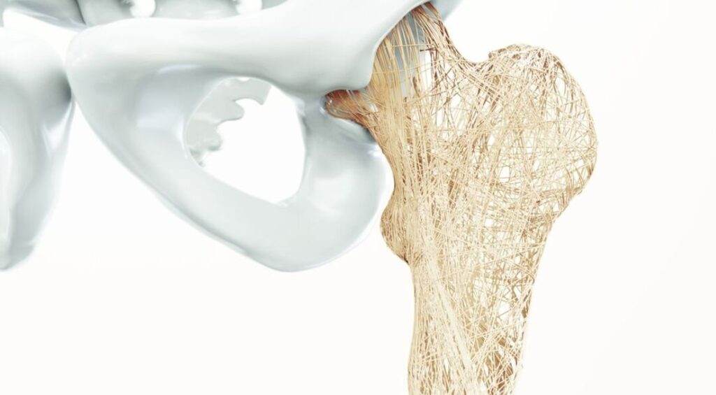 Faktori rizika za nastanak osteoporoze